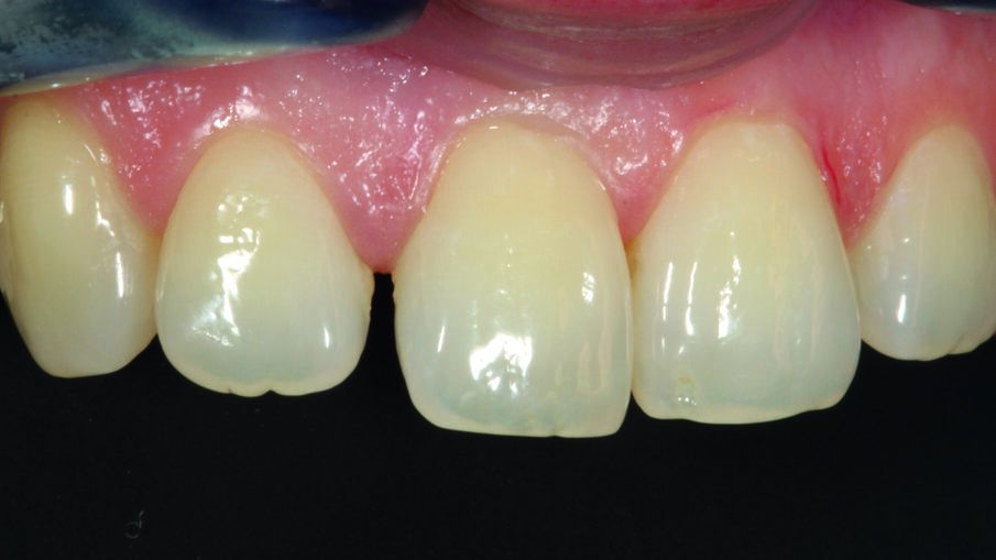 Afbeelding 2. Beginsituatie: opening tussen middelste en laterale rechter snijtand. Van rechts-zijdelings gezien.