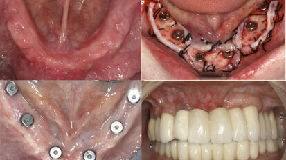 Nuevos métodos para obtener encía queratinizada alrededor de los implantes dentales