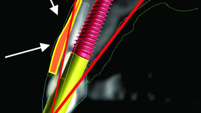 3b: The simulated implant within the Triangle of Bone (red), placed to avoid the root fragment seen in yellow (white arrows).