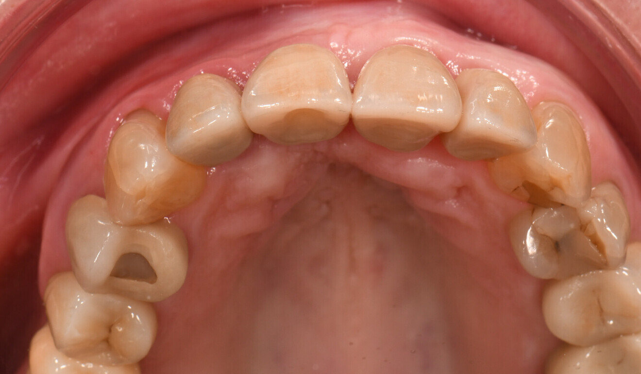 Fig. 15: Immediate treatment outcome, occlusal view.