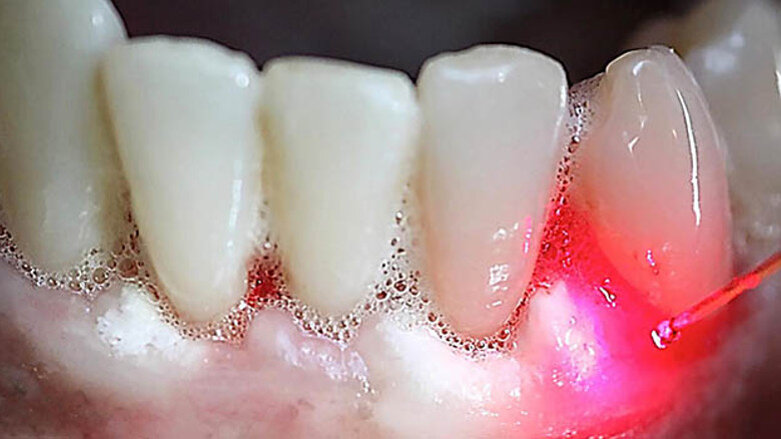 Fomation inédite au laser