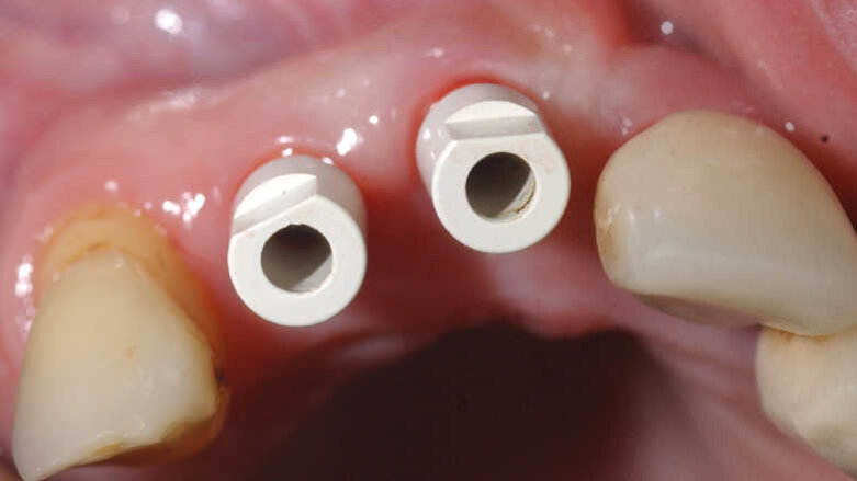Chirurgie guidée et mise en charge immédiate. Résultats cliniques et radiologiques