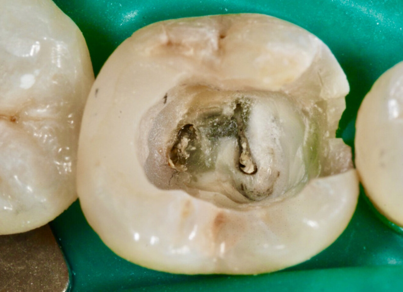 Fig. 22 : Après le retrait de la restauration coronaire, l’extension excessive est visible au niveau apical, mésial et lingual, ainsi que l’absence d’instrumentation des canaux vestibulaires.