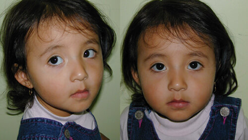 La protracción maxilar precoz sin expansión