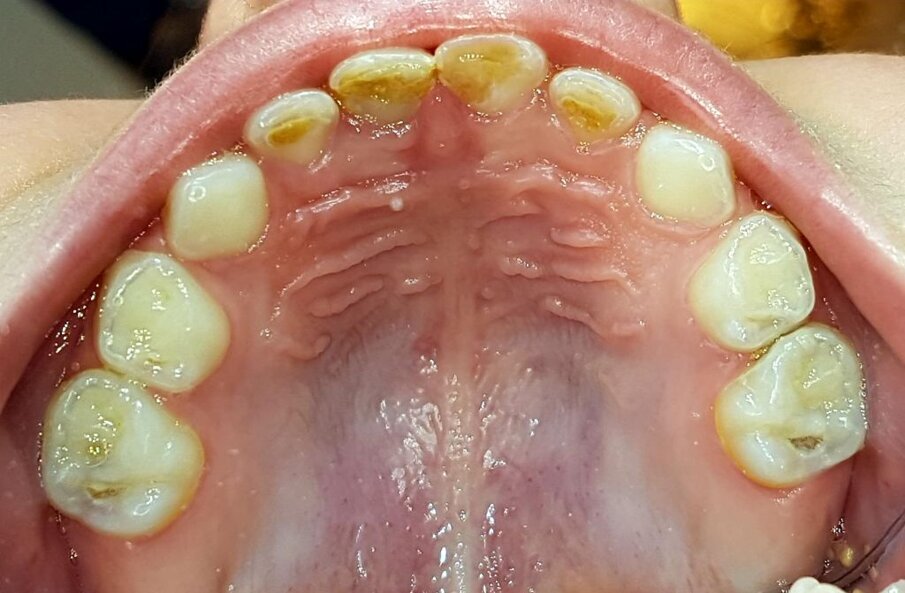 Afbeelding 6a. Multi-cariës bij intake.