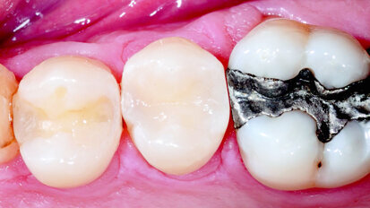 Class II DO on Second Bicuspid. Case Study