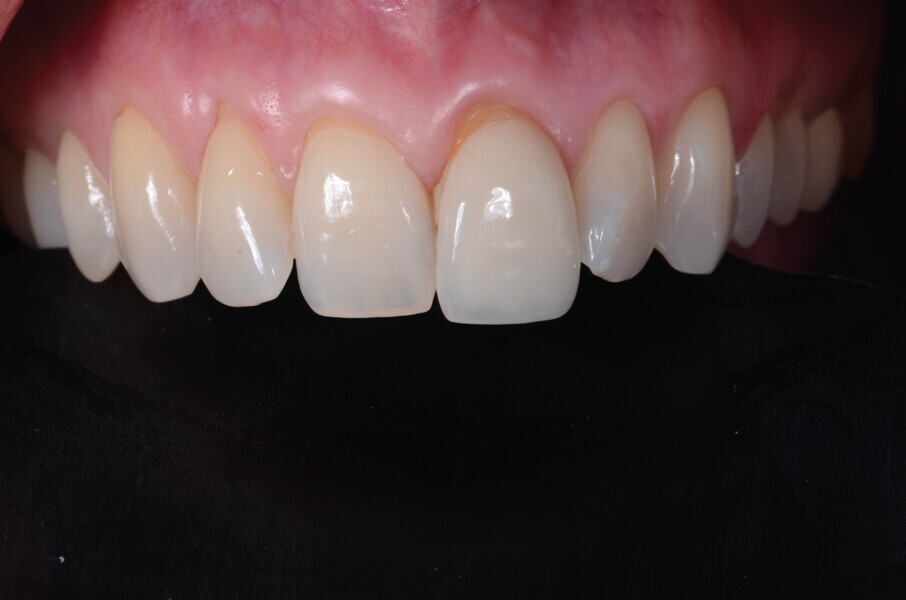 Fig. 2a : Vue préopératoire intraorale