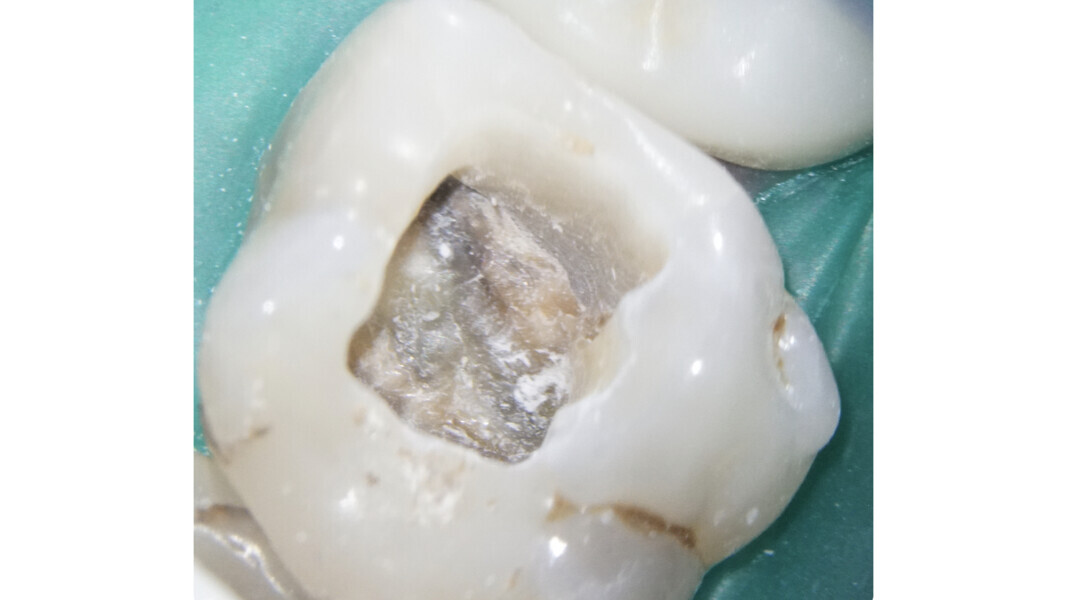 Fig. 29 : Repérage de points blancs constitués de poudre dentinaire, accumulée au niveau des orifices canalaires durant l’élimination sélective au moyen du système EndoTracer.