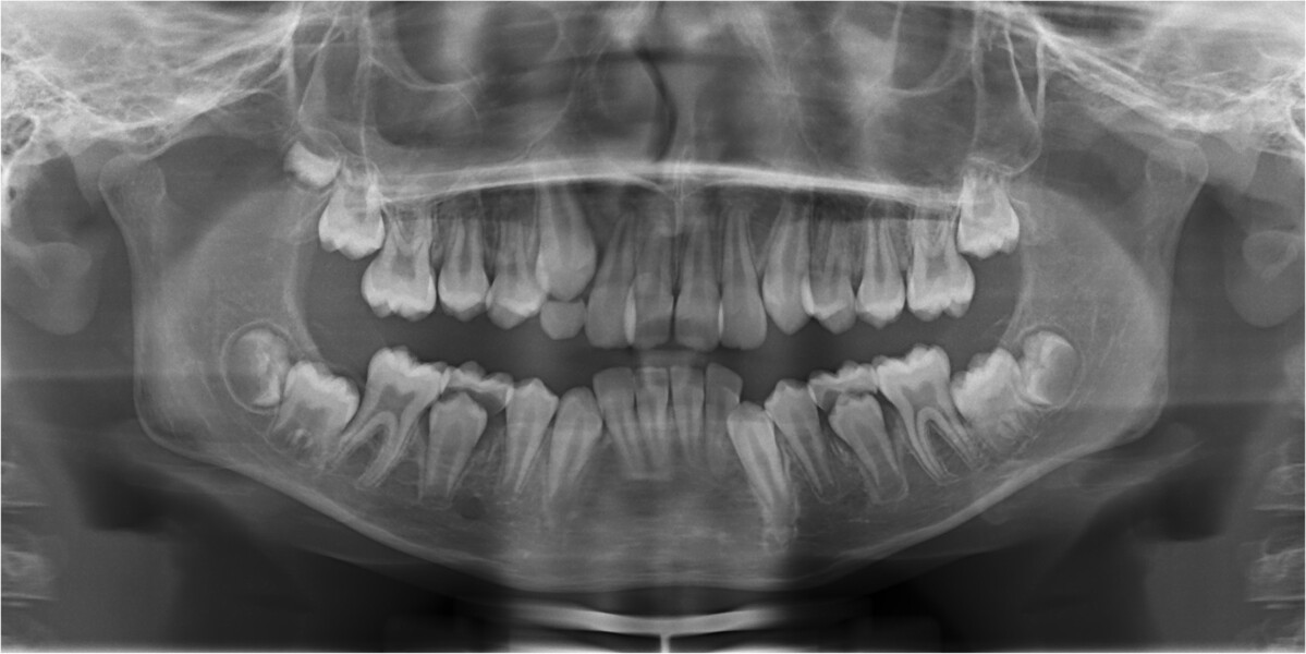 Fig. 3: Pretreatment panoramic radiograph.