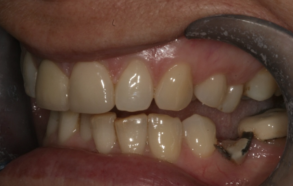 Fig. 4: 2004—lateral view of the initial clinical situation.