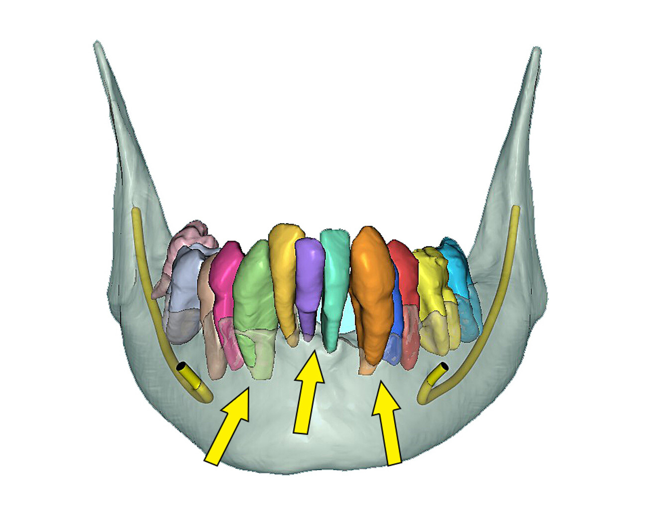 Fig. 13b: Selective transparency view visualising the roots, bilateral mental nerves and inferior alveolar nerve (yellow arrows point to the apices of the roots, showing the extent of the bone loss).