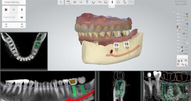 Implant Studio da 3Shape é autorizado para vendas pela autoridade sanitária americana