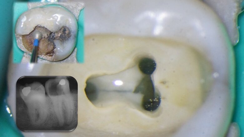 Three questions about the management of complex root canal anatomy