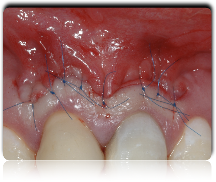 Figg. 9-11 - Fasi dell’apicectomia eseguita in attesa della completa maturazione dei tessuti parodontali.