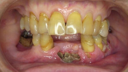 Bisfosfonaten verhogen risico op osteonecrose in kaak