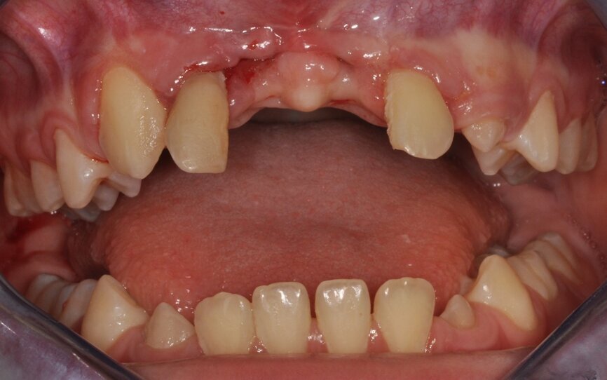 Ryc. 8_Stan miejscowy bezpośrednio przed autotransplantacją.