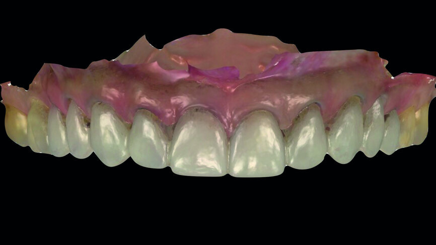 Fig. 12a: Digital planning of the provisional restorations.