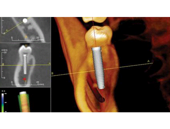 Le cone beam et les implants : une expérience qui change une carrière