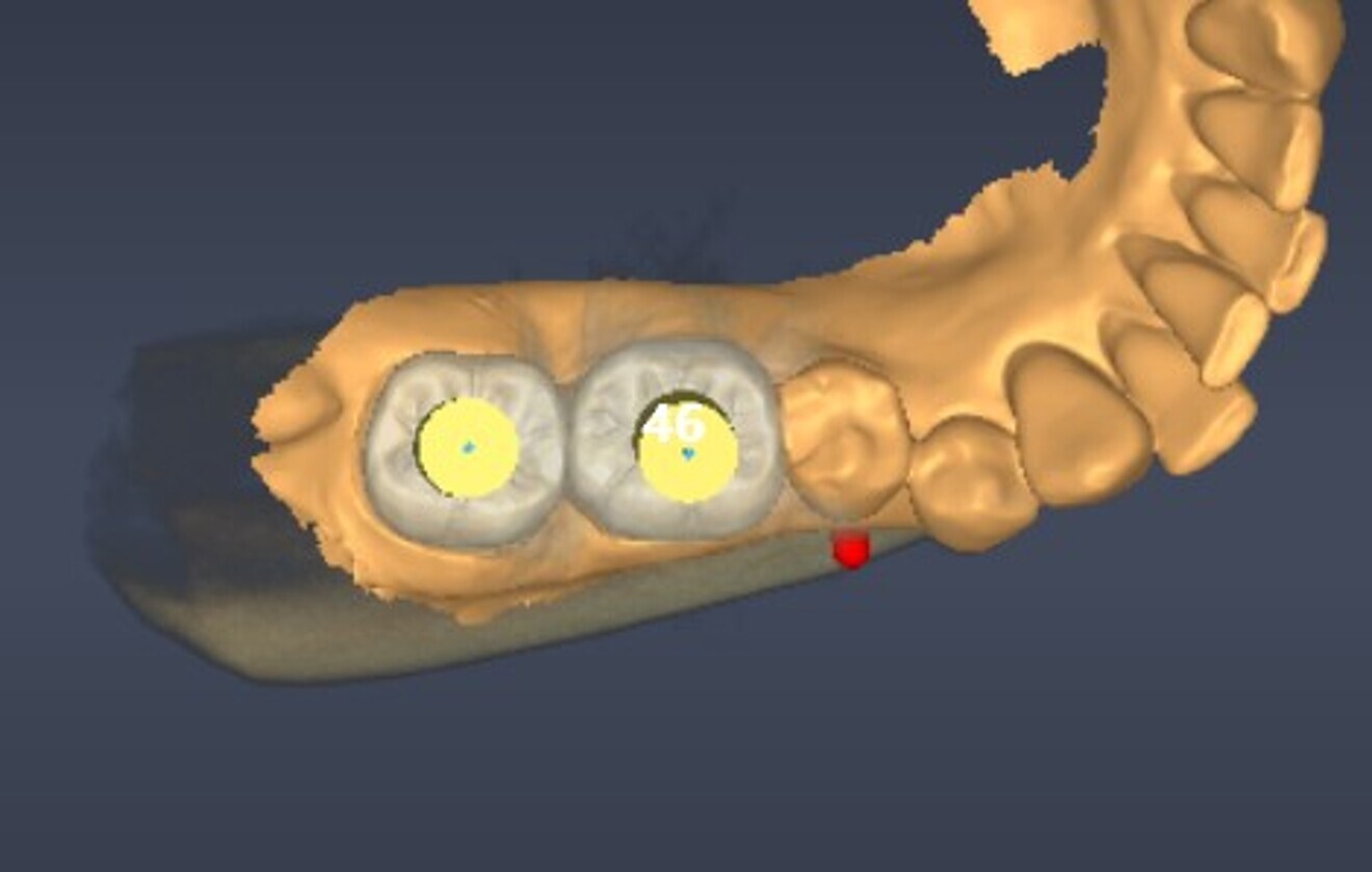 Fig. 4: Digital implant planning, occlusal view. 