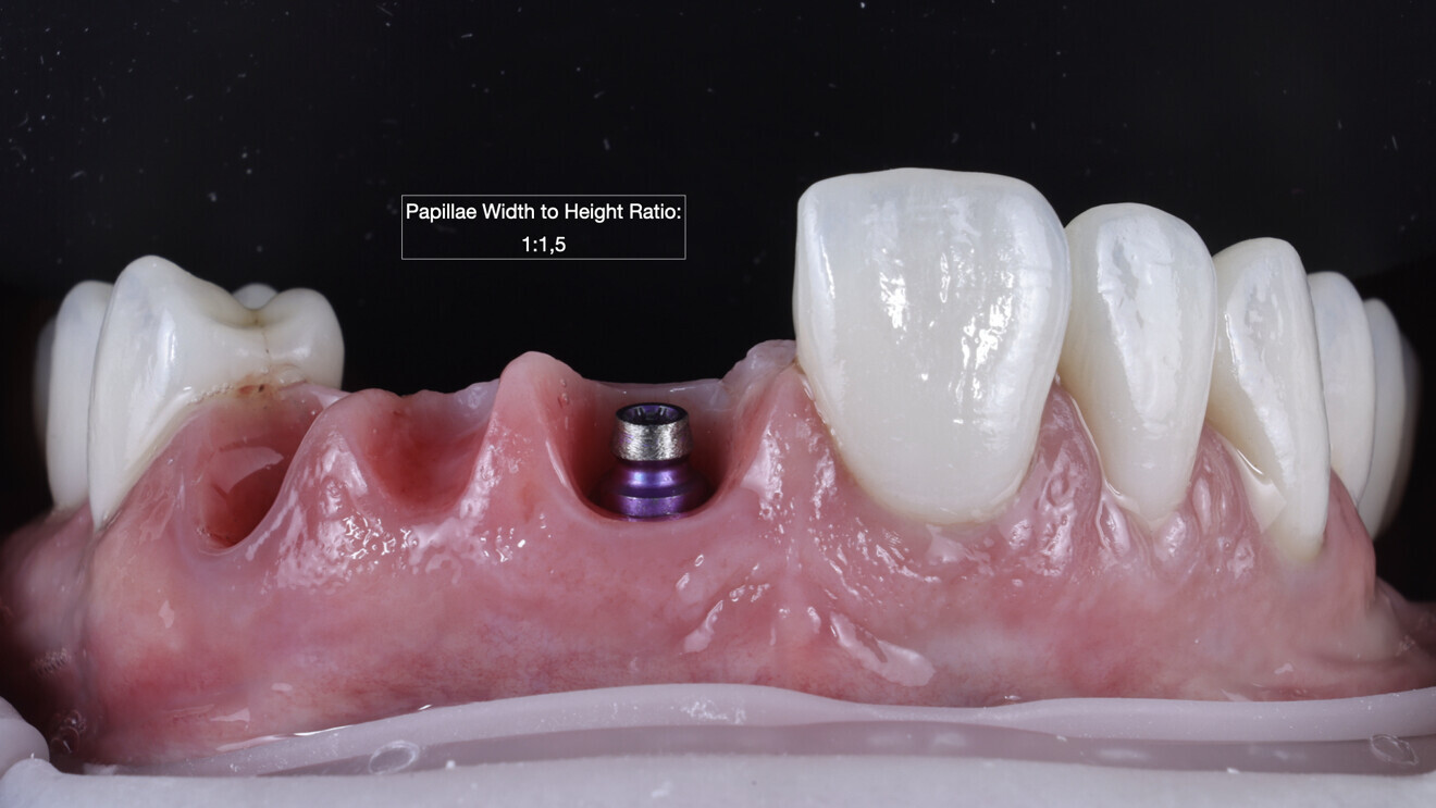 Figs. 33 & 34: Appearance of the papillae on the day of cementation. 