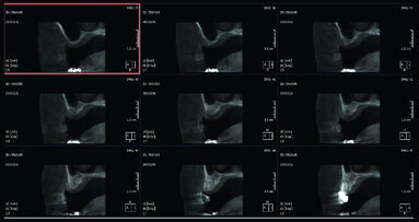 Rialzo di seno con accesso laterale e innesto di impianti autofilettanti SPI in mascellare atrofico