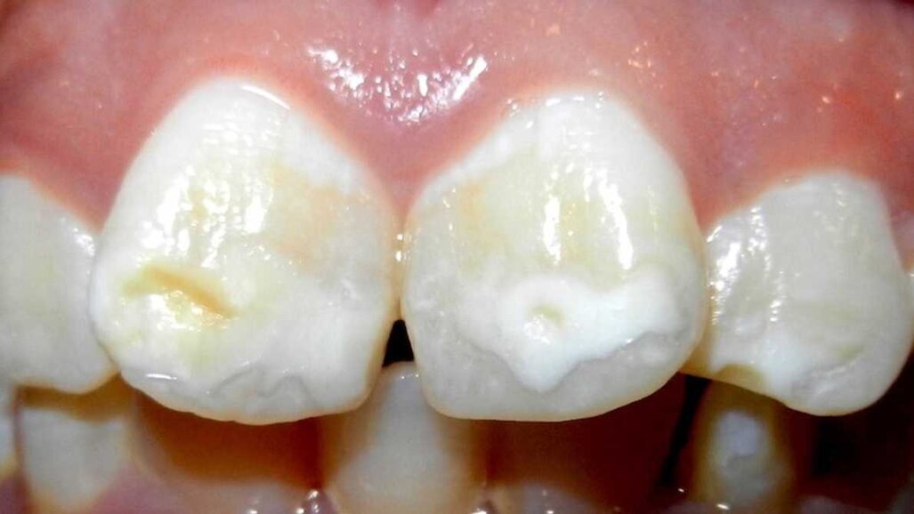 Colgate lanza un Advisory Board sobre mancha blanca en ortodoncia