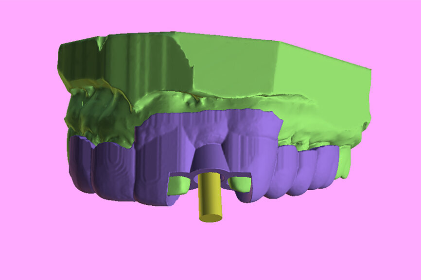 Fig. 6b: Two 3D-printed templates designed on the digitised model (green): one for the initial drill to section the tooth at the root apex (a) and the second for using sequential guided drills to drill through the root itself (b).