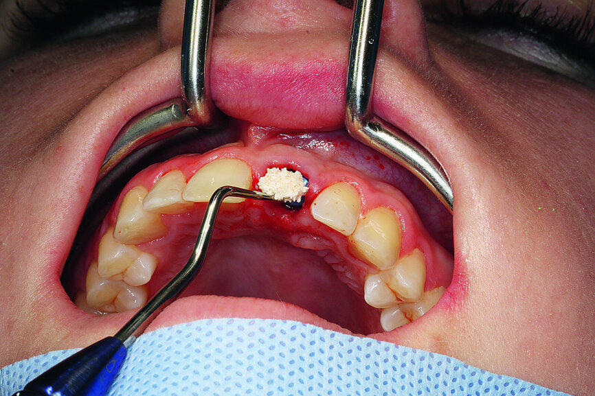 Fig. 11: Augmentation of the vestibular alveolus.