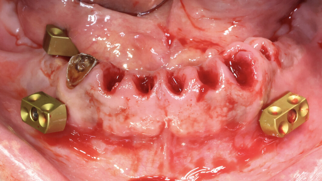 Fig. 8a: Preparation for robotic computer-assisted implant surgery. Bone-anchored fiducial markers affixed to the mandible for registration with the robotic system.