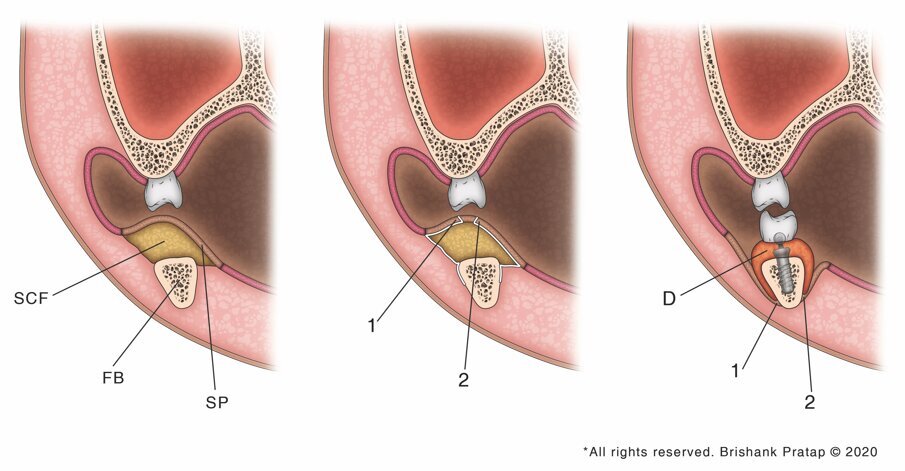 Fig 1: Schematic diagram of the DGER technique.