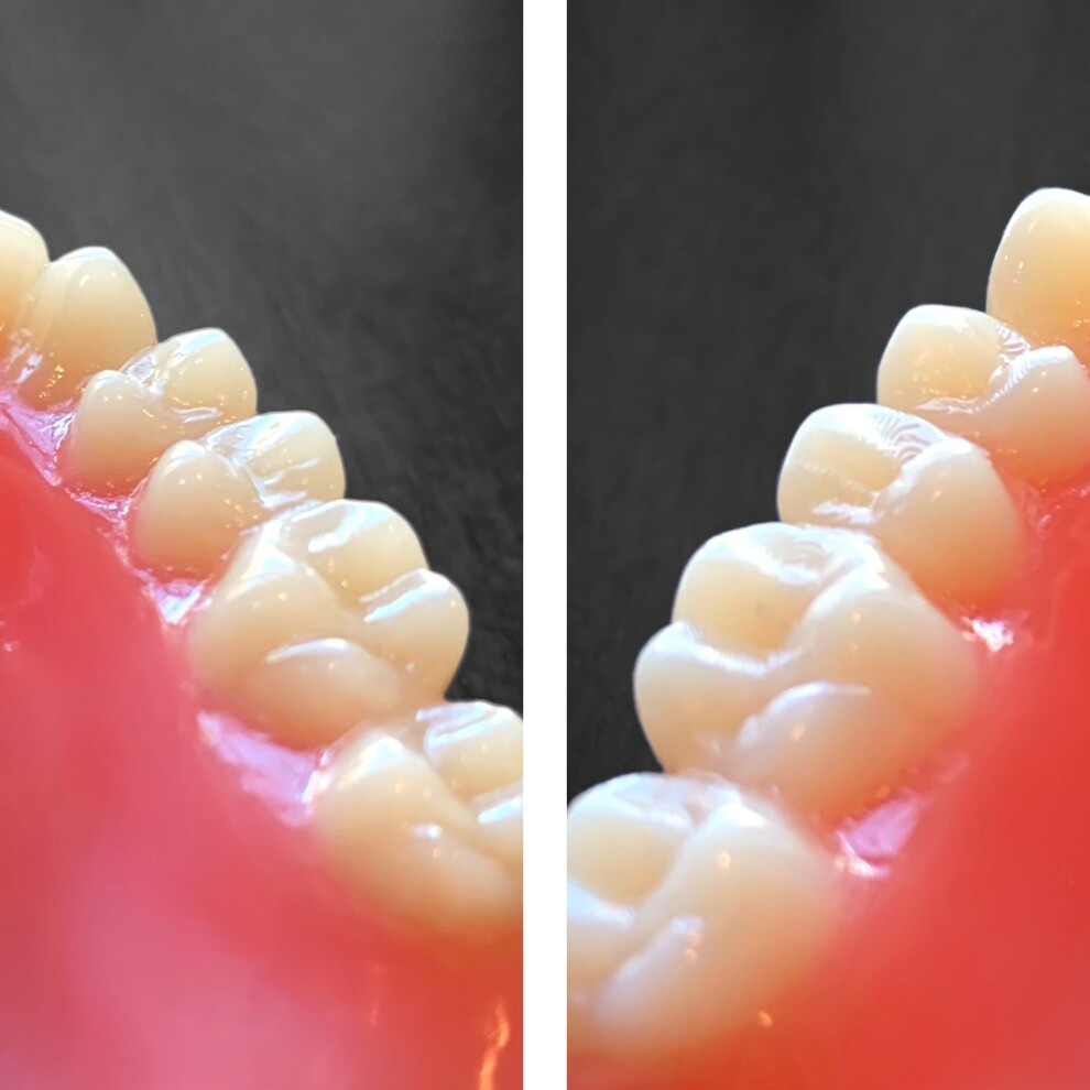 Milled prosthetic teeth (left) and printed prosthetic teeth. The layer-by-layer build-up of the printed teeth is clearly visible. These surface steps must be manually smoothed to minimise plaque retention.