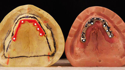 L’importanza della progettazione protesica: un caso clinico di protesi rimovibile su impianti