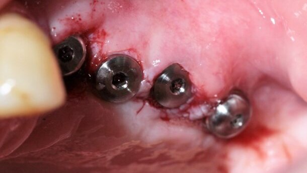 Zastosowania indywidualnej siatki tytanowej w augmentacji wyrostka zębodołowego szczęki z wykorzystaniem rhPDGF – część II