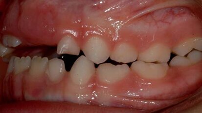 Lasery w stomatologii dziecięcej - perspektywa kliniczna