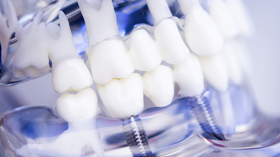 Bessere Osseointegration: Beschichtete Implantate entwickelt