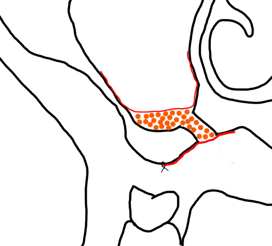 Ryc. 3_Wprowadzenie materiału kościozastępczego oraz zreponowanie i zaszycie płata śluzówkowo-okostnowego.