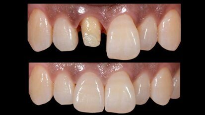 Rehabilitación estética de un diente anterior