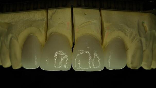 Lithium disilicate—An effective solution for aesthetically demanding indications