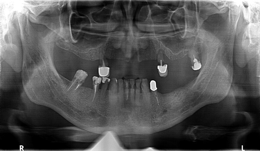 Fig. 29: OPG prior to treatment.