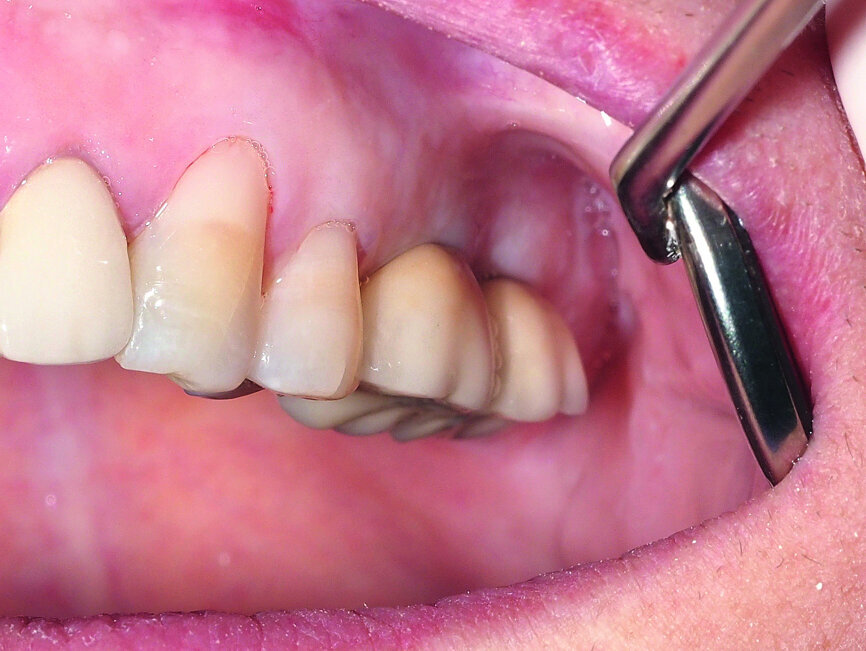 Fig. 12: Splinted, screw-retained metal-ceramic restoration for better load transfer.