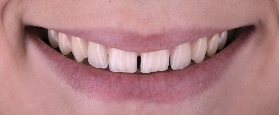 Fig. 1: Initial situation: The patient wants to have an esthetic solution for her diastema.