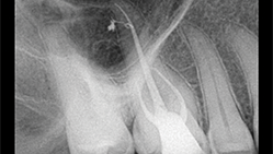 Efekat primene parcijalnog vakuuma na hemijsku obradu sistema kanala korena: Sleimanova faza