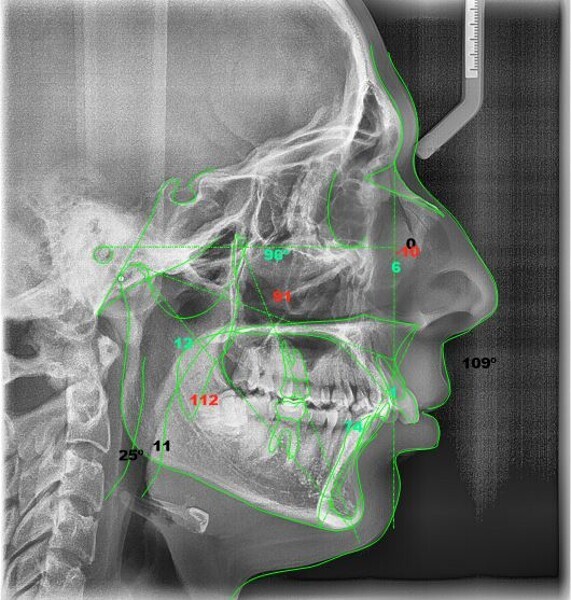 Fig. 7: McNamara cephalometric analysis (image generated using NemoCeph Studio).