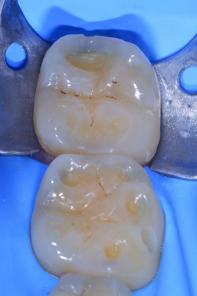 Figg. 2-5_Rimozione dei vecchi restauri presenti su 4.6 e 4.7: gli elementi vengono restaurati con tecnica diretta utilizzando dentina e smalto Enamel Plus HRI Bio Function. 