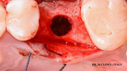 Impianto corto associato a carico immediato, Sinus lift e GBR con Endoret-PRGF su elemento singolo