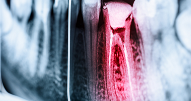 Wirtschaft und Stress führen zu schlechten Wurzelfüllungen