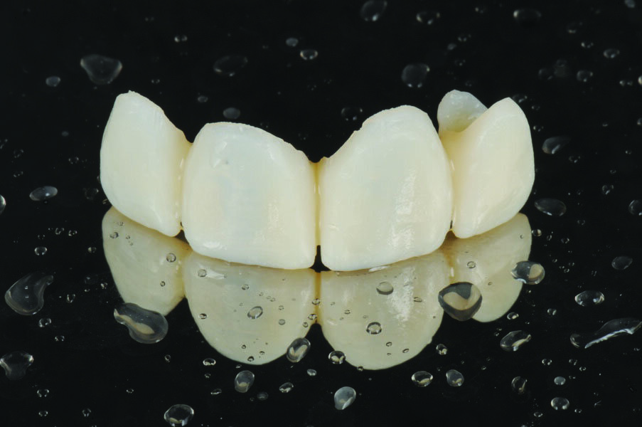 Fig. 6: Finished temporary restoration.