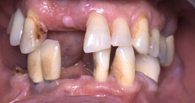 Huit implants pour un sourire