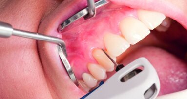 Ultradźwięki pomagają w walce z chorobami przyzębia