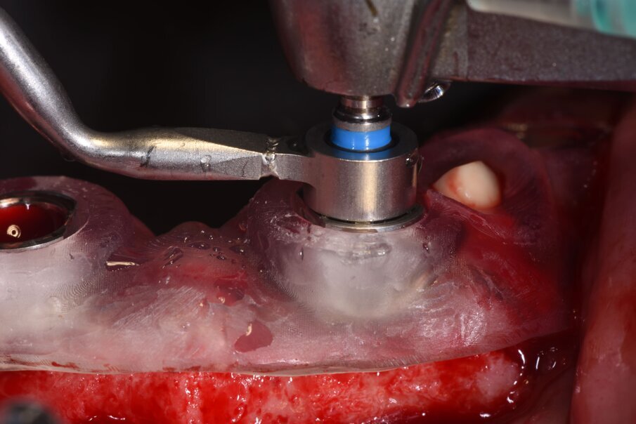Fig. 19_La dima chirurgica per essere stabile deve avere il maggior appoggio disponibile evitando l’interferenza con i lembi e lasciando degli opercoli che possano consentire la visione dell’avventata calzata corretta. Visione della prima fresa pilota da 2.2 mm con il posizionatore correlato. Se non fosse raggiunto una adeguata stabilità è possibile dopo questo primo passaggio poter posizionare uno stop che si inserisce nel foro praticato nella porzione ossea.